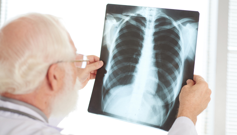 Schluckauf als Warnsignal: Diese Krankheiten können dahinterstecken